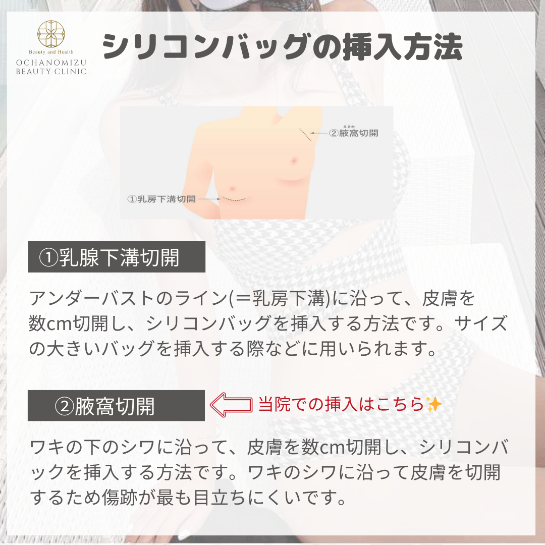 シリコン豊胸の手術方法についてご紹介✨ | 御茶ノ水の美容皮膚科 