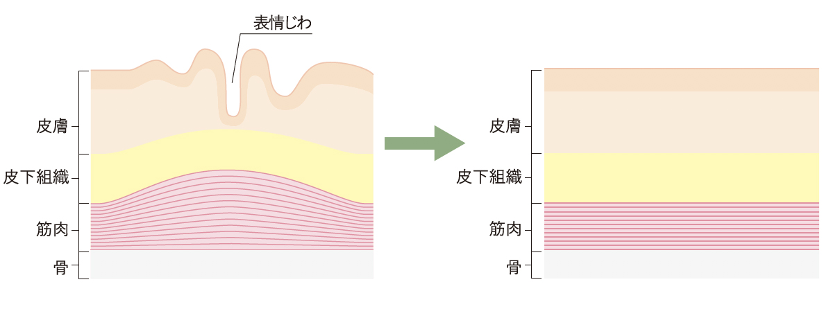 ボトックス治療