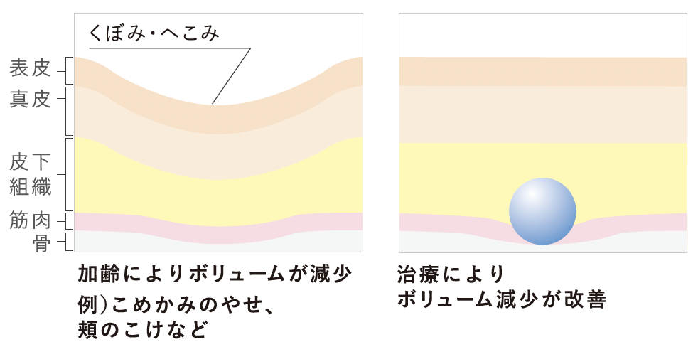 ヒアルロン酸