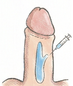 陰茎増大のイメージ図