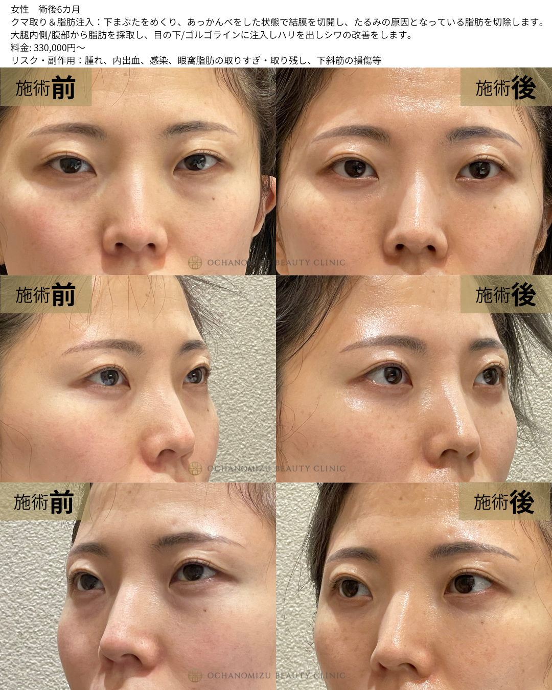 クマとり脂肪注入の症例