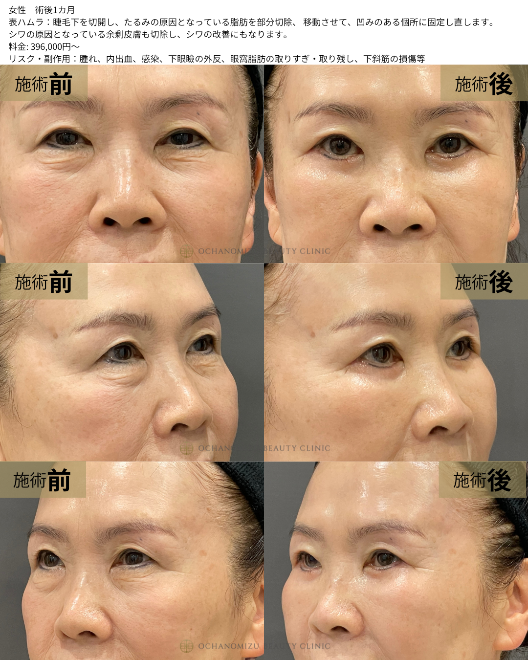 表ハムラの症例