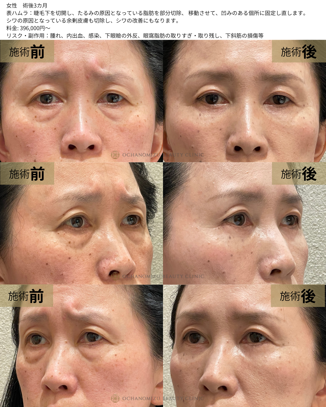 表ハムラの症例