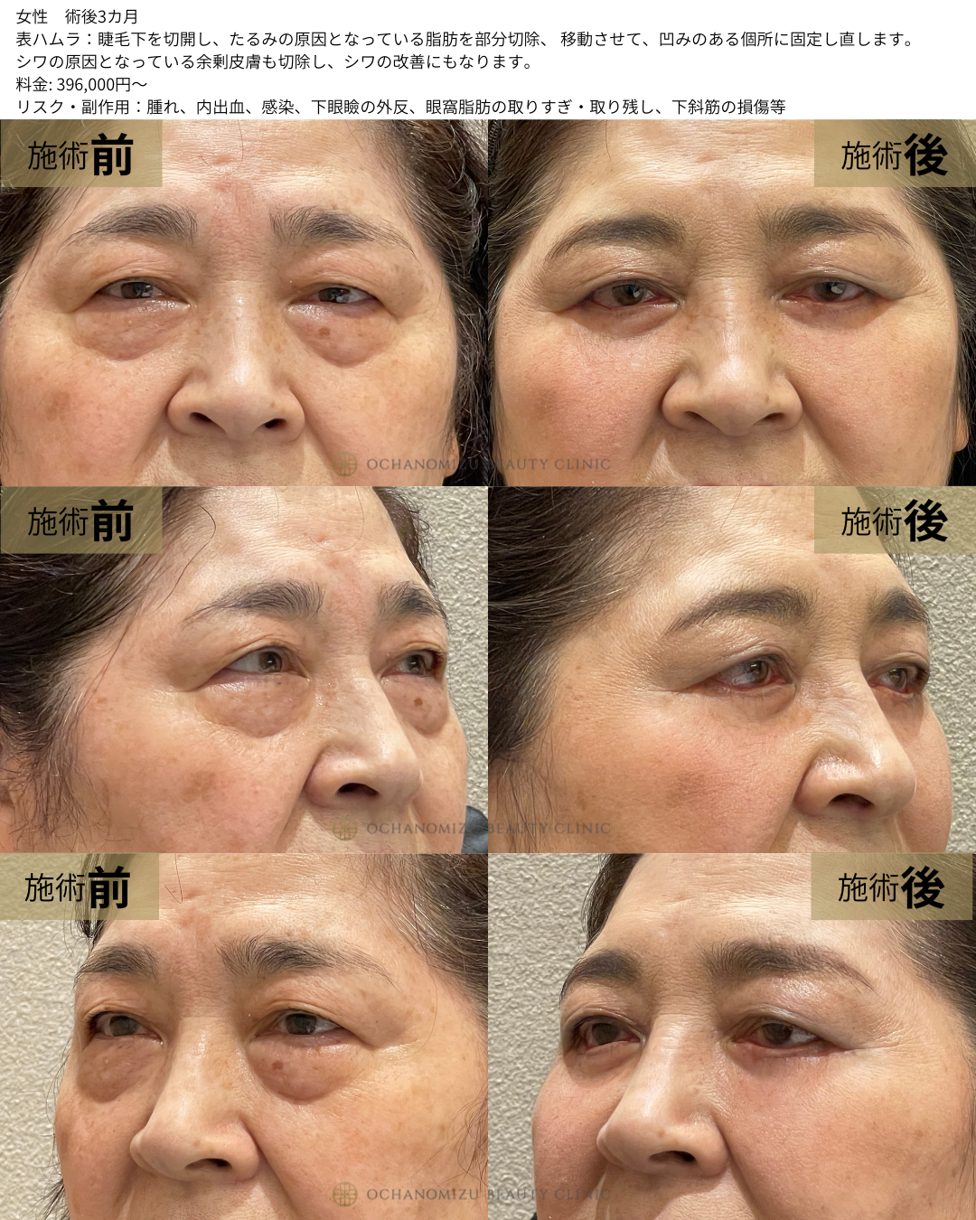 表ハムラの症例