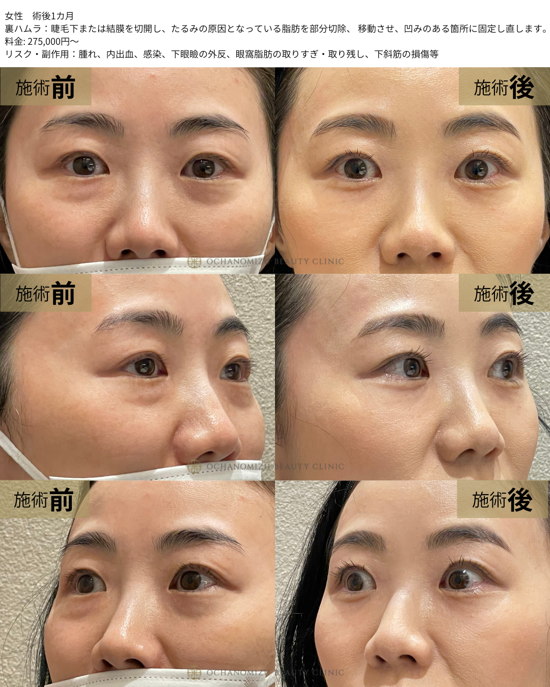 裏ハムラの症例
