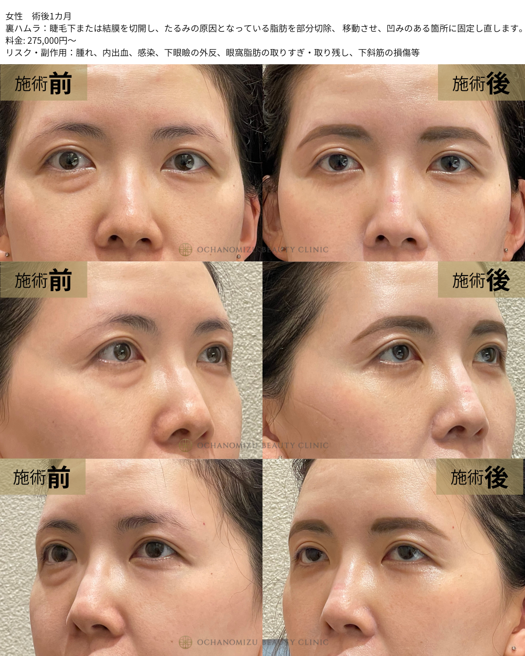 裏ハムラの症例