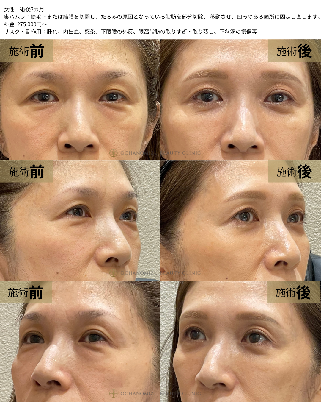 裏ハムラの症例