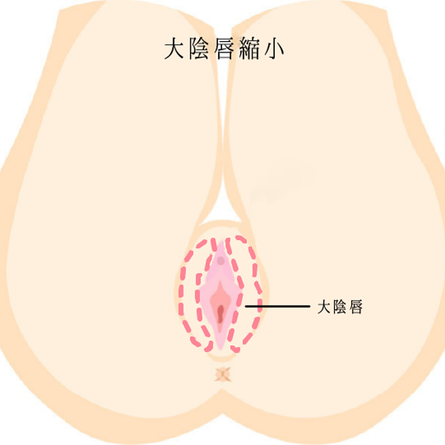 大陰唇縮小・大陰唇形成術