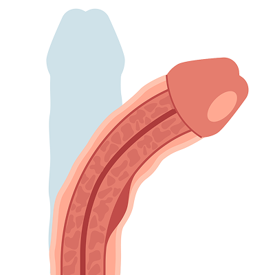 形状改善（ブツブツ除去・シリコンボール挿入）とは