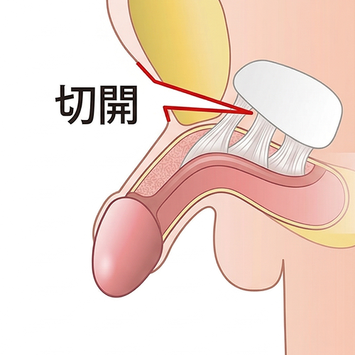 長茎術