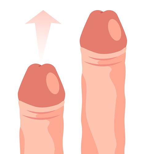 長茎・形状改善・パイプカット