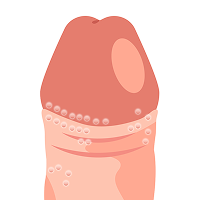 亀頭周辺の小さな白いブツブツ