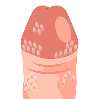 カリフラワー状のイボ