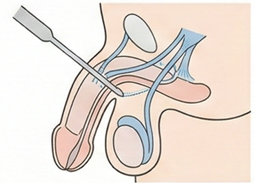 切らない長茎術のイメージ図