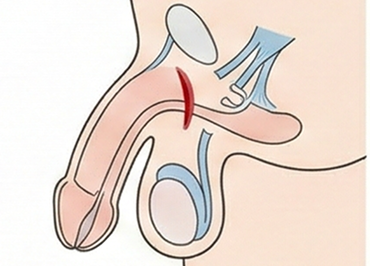 切る長茎術のイメージ図