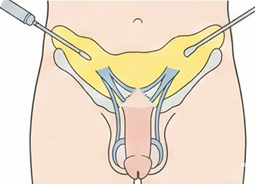 脂肪吸引併用長茎術のイメージ図