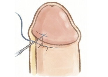 亀頭直下埋没法のイメージ図