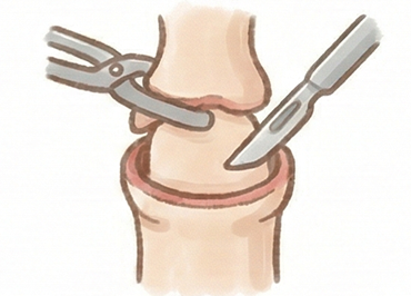 環状切開法のイメージ図