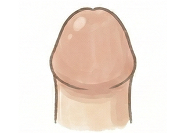 亀頭直下埋没法のイメージ図