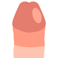 勃起時の皮膚の余裕を精密に計算せず、単に余っている皮を切り取って縫合