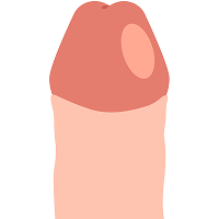 不自然になってしまった色の境目を含む皮膚を計算して切除し、再構築