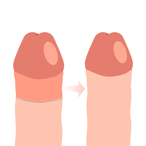 シリコンボール挿入