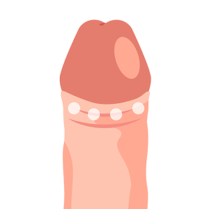 シリコンボール挿入 