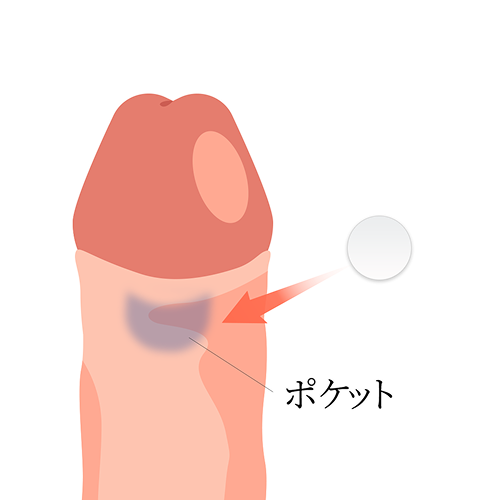 シリコンボール挿入