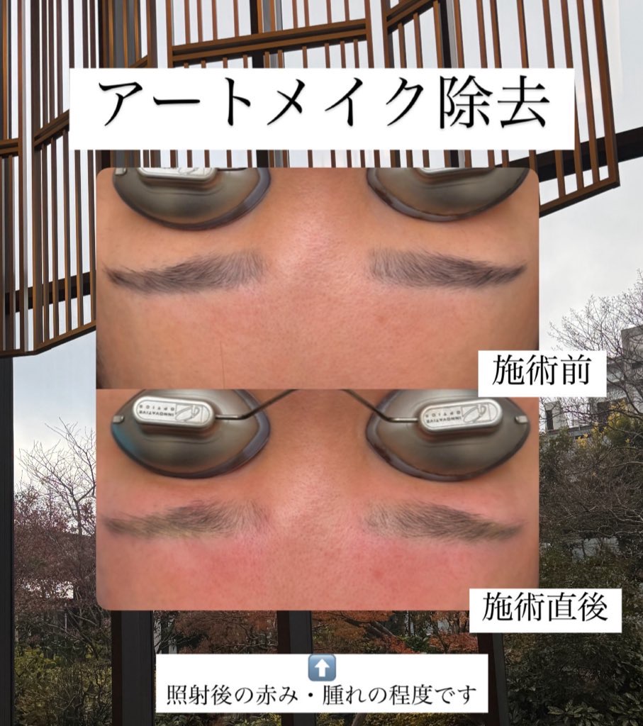 アートメイク除去施術の様子
