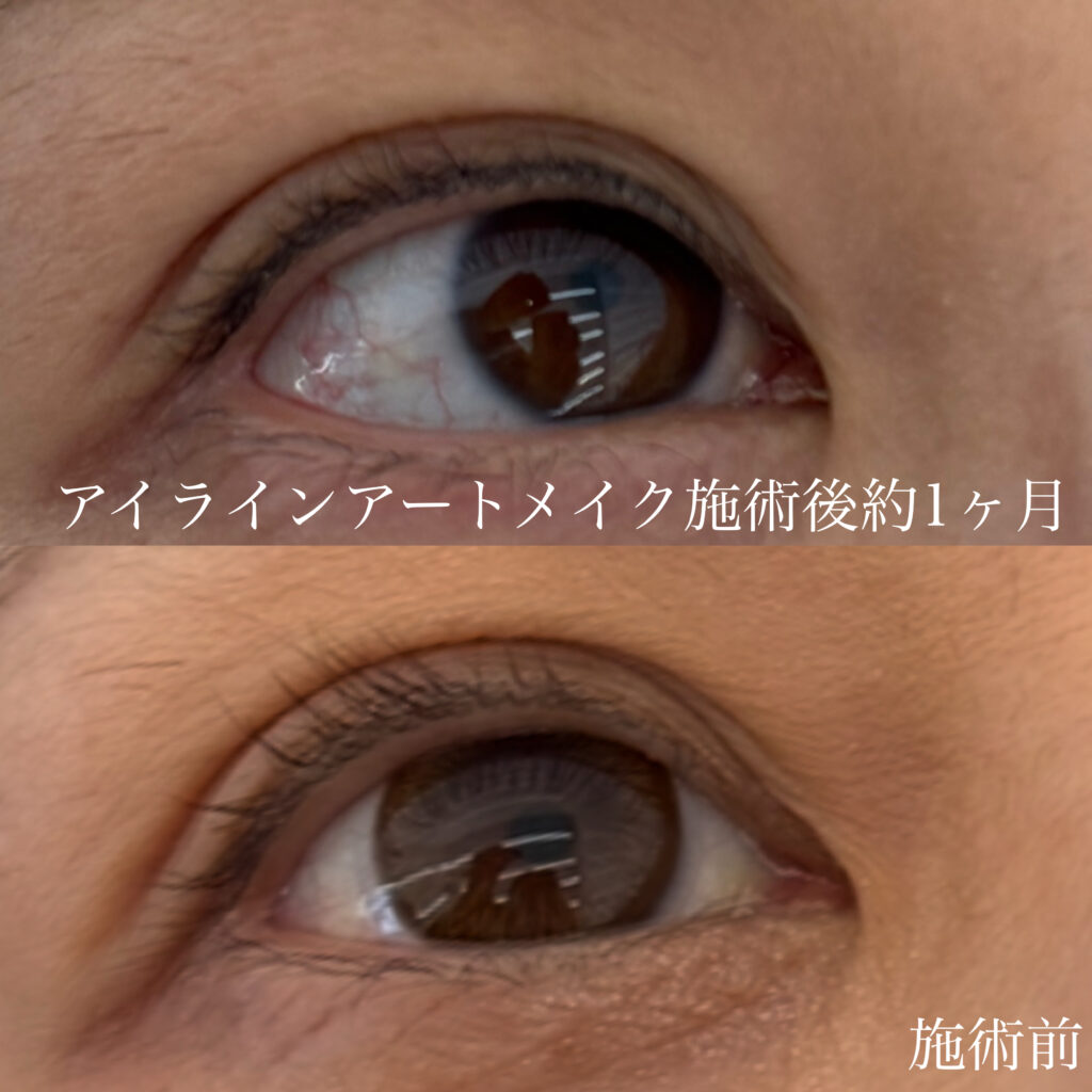 アイラインアートメイク施術後約1ヶ月