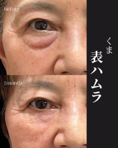 表ハムラ