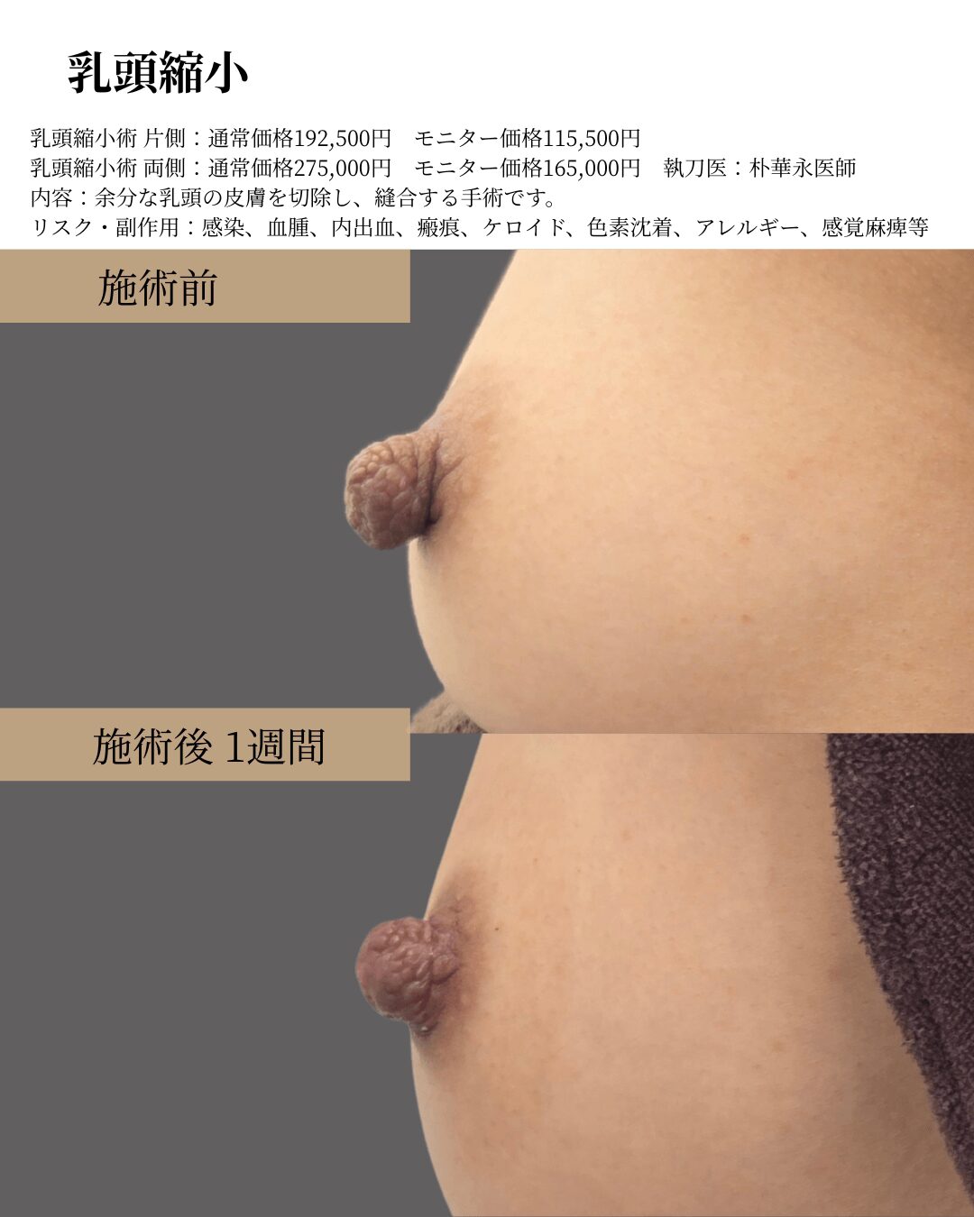 乳頭縮小の症例