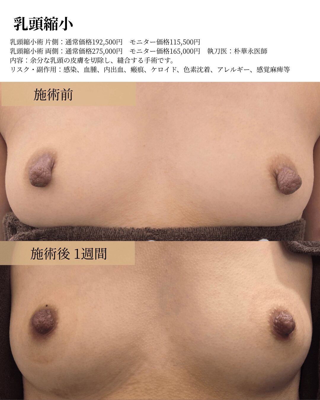 乳頭縮小の症例