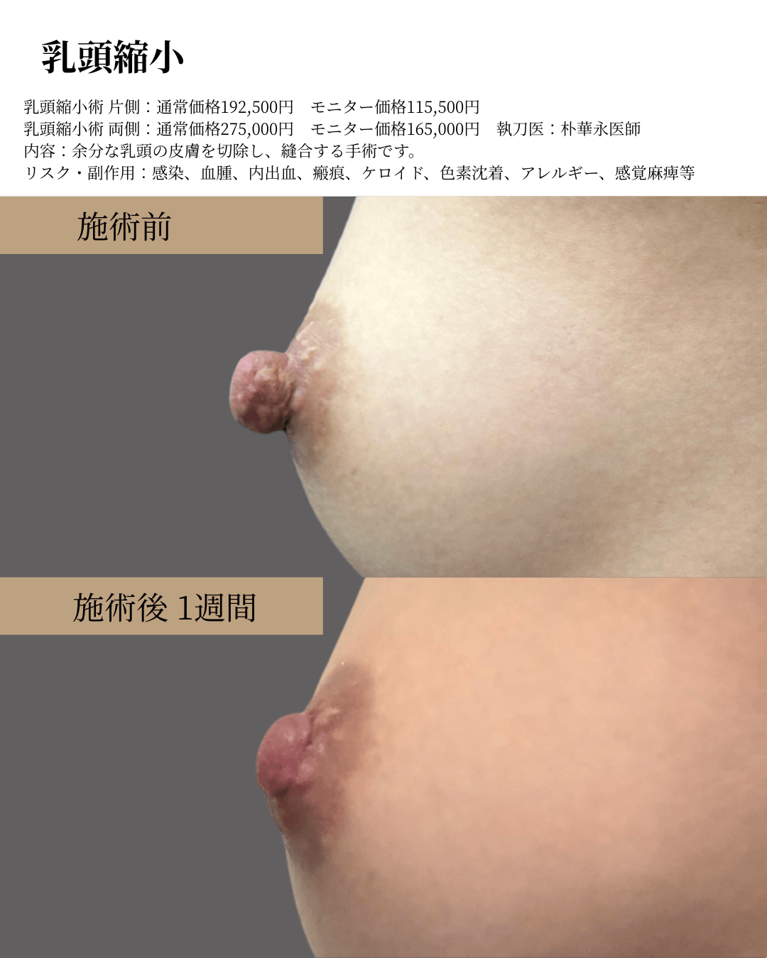 乳頭縮小の症例