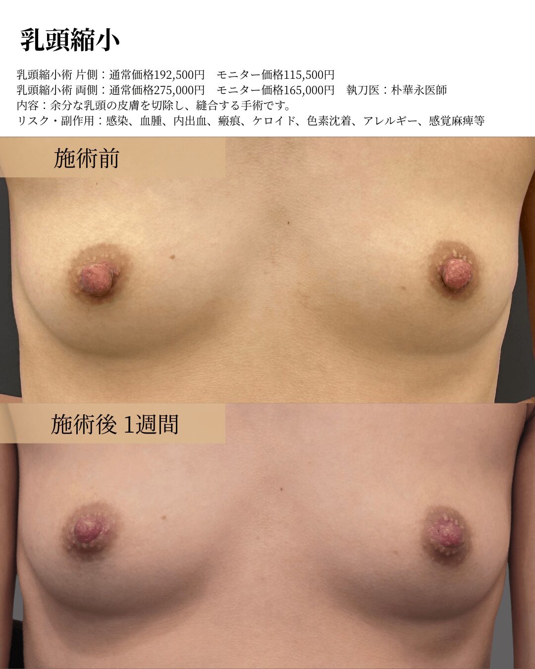 乳頭縮小の症例