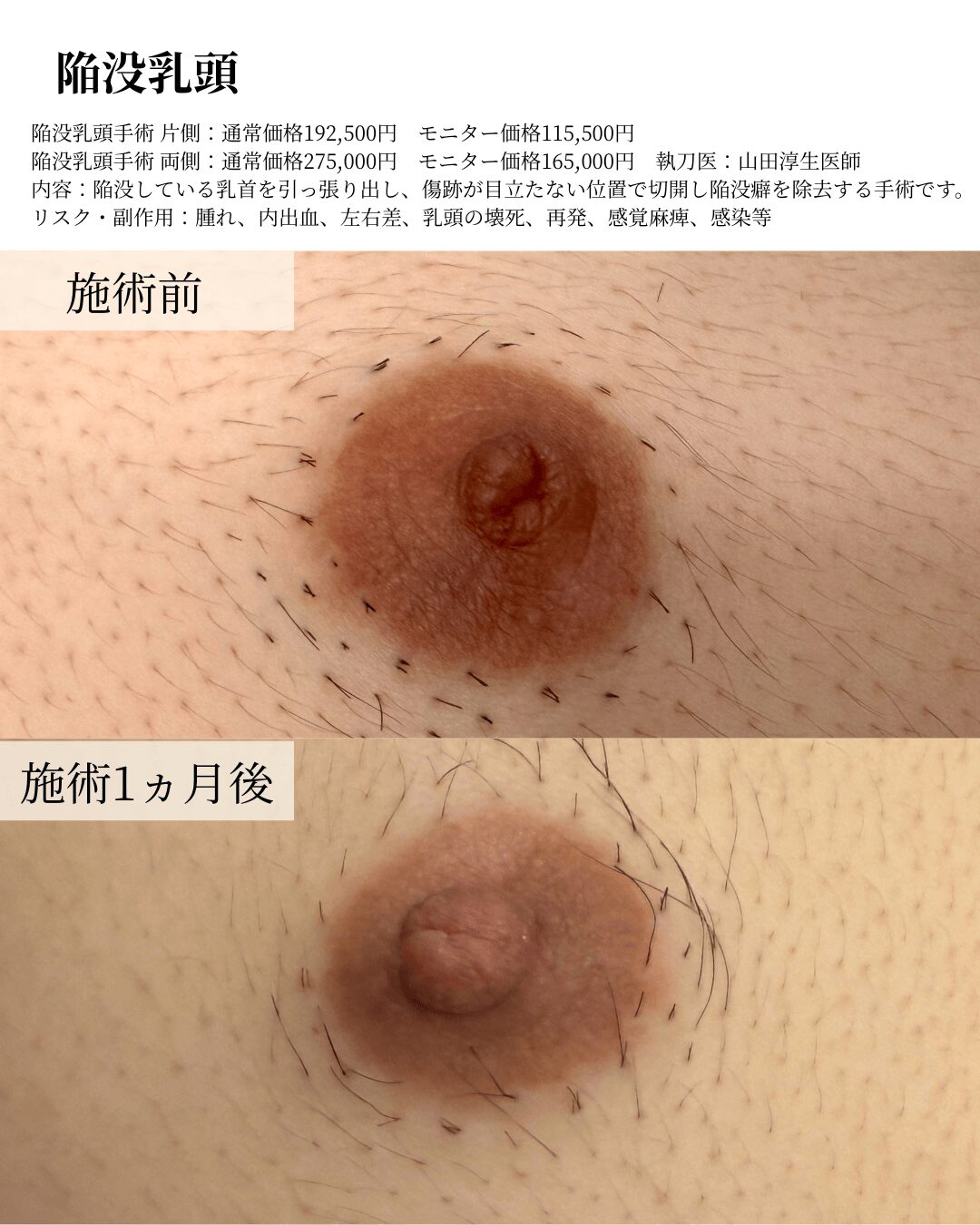 陥没乳頭の症例