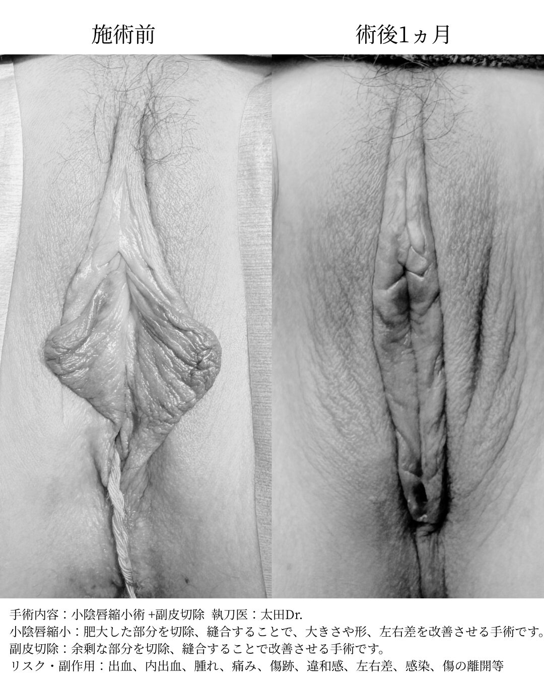 小陰唇縮小術 +副皮切除