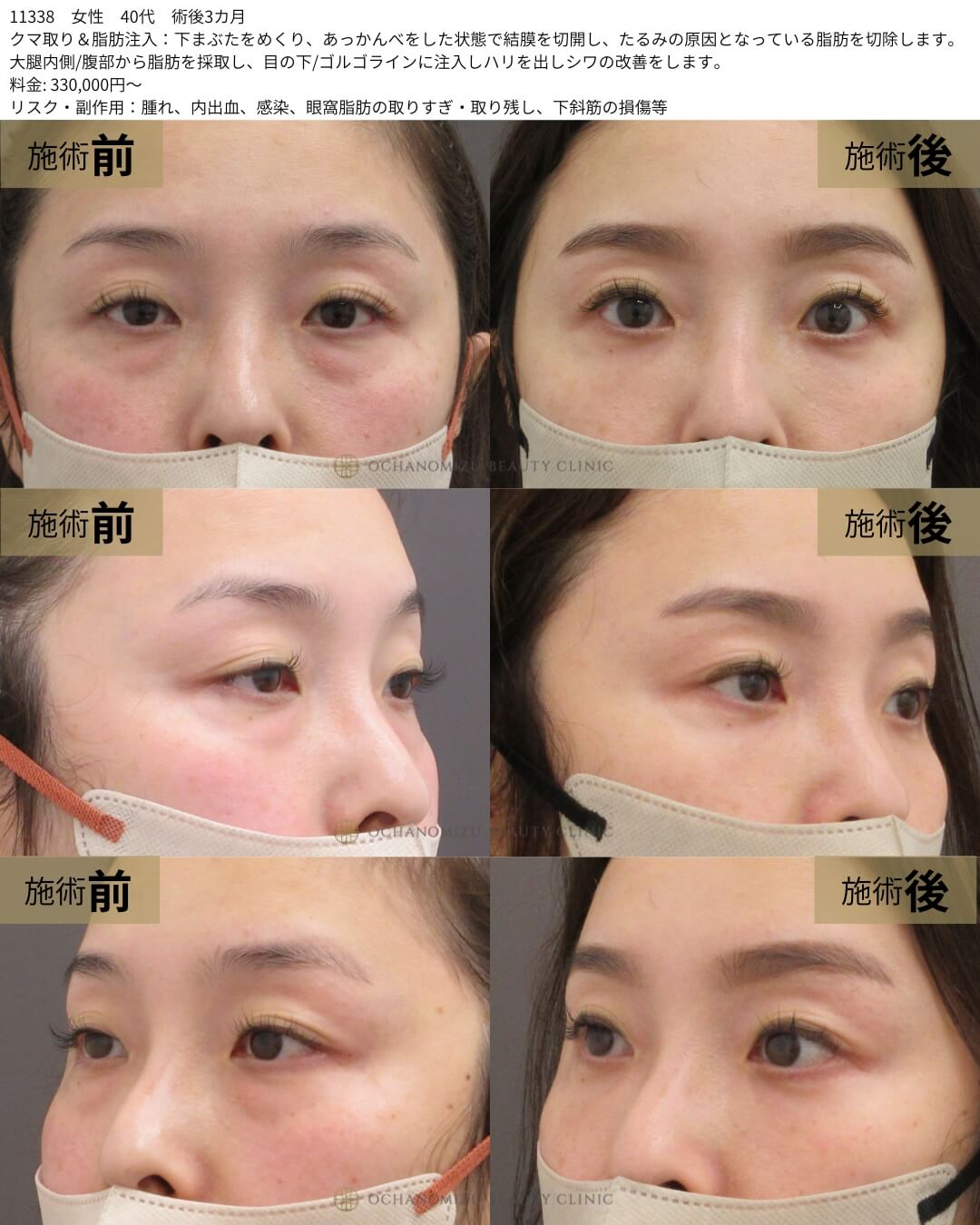 クマ取り＆脂肪注入