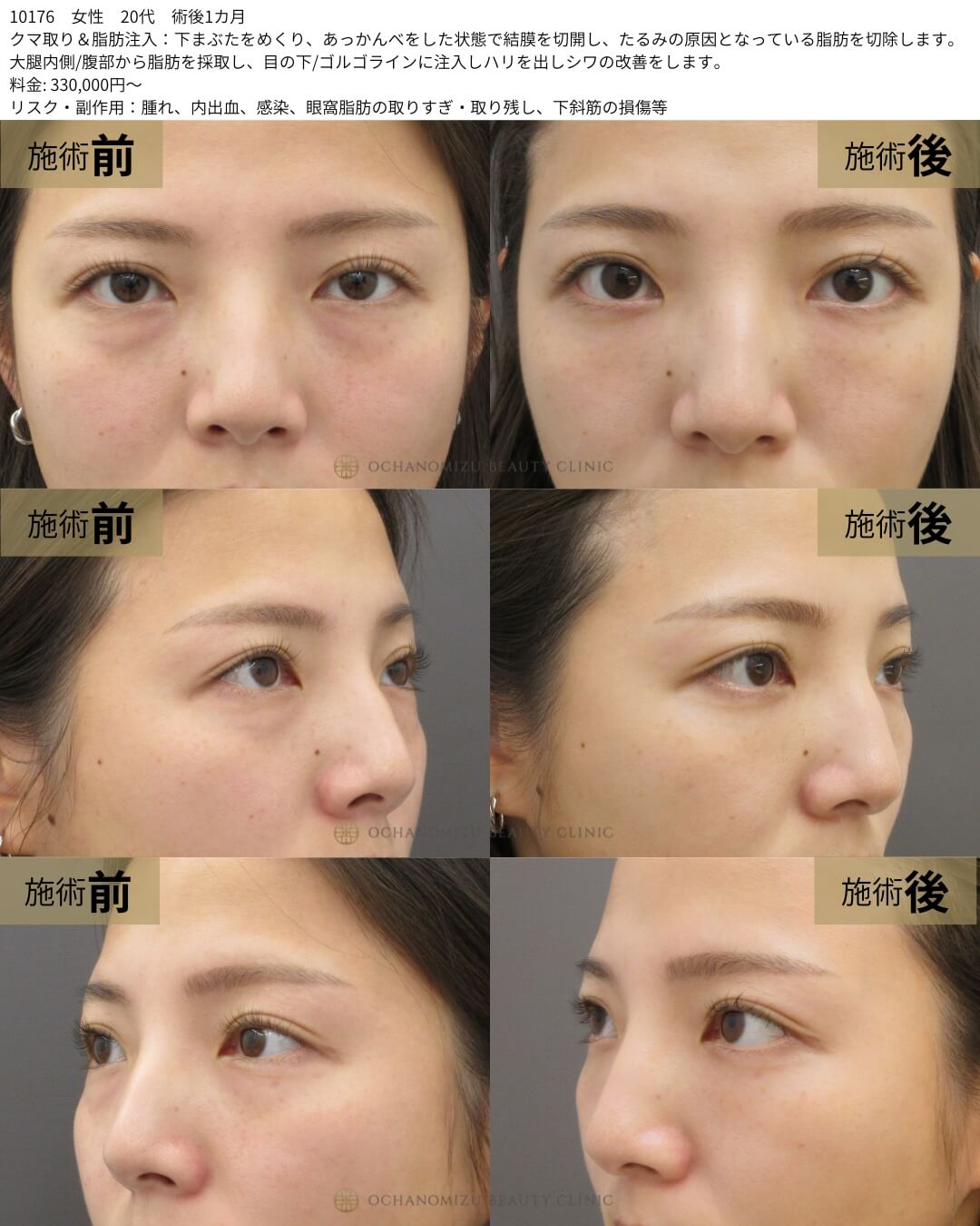 クマ取り＆脂肪注入