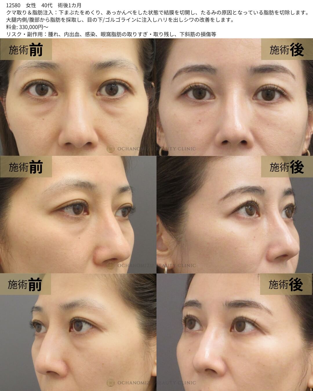 クマ取り＆脂肪注入