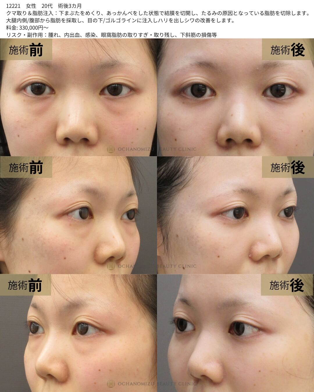 クマ取り＆脂肪注入