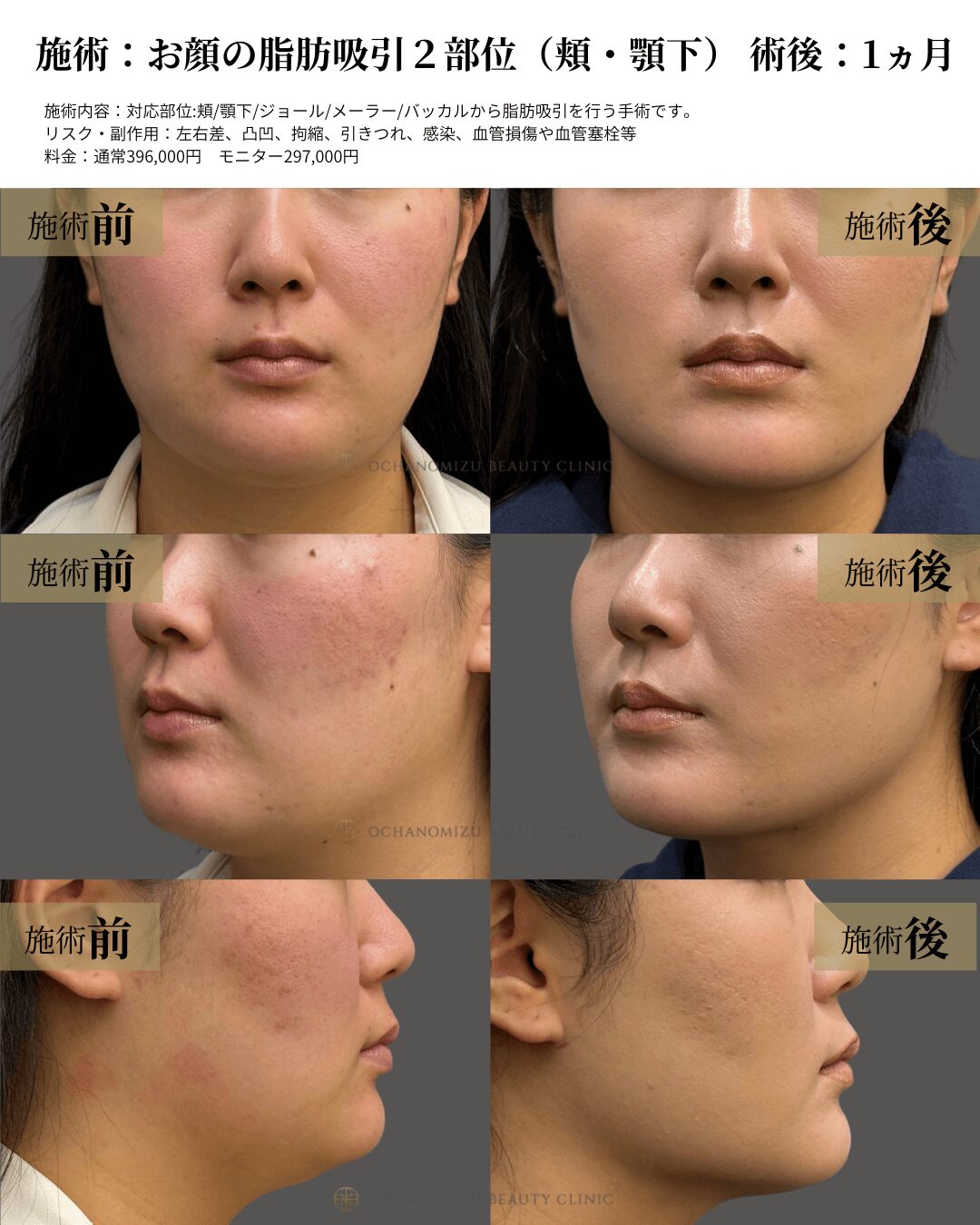 お顔の脂肪吸引2部位（頬・顎下）