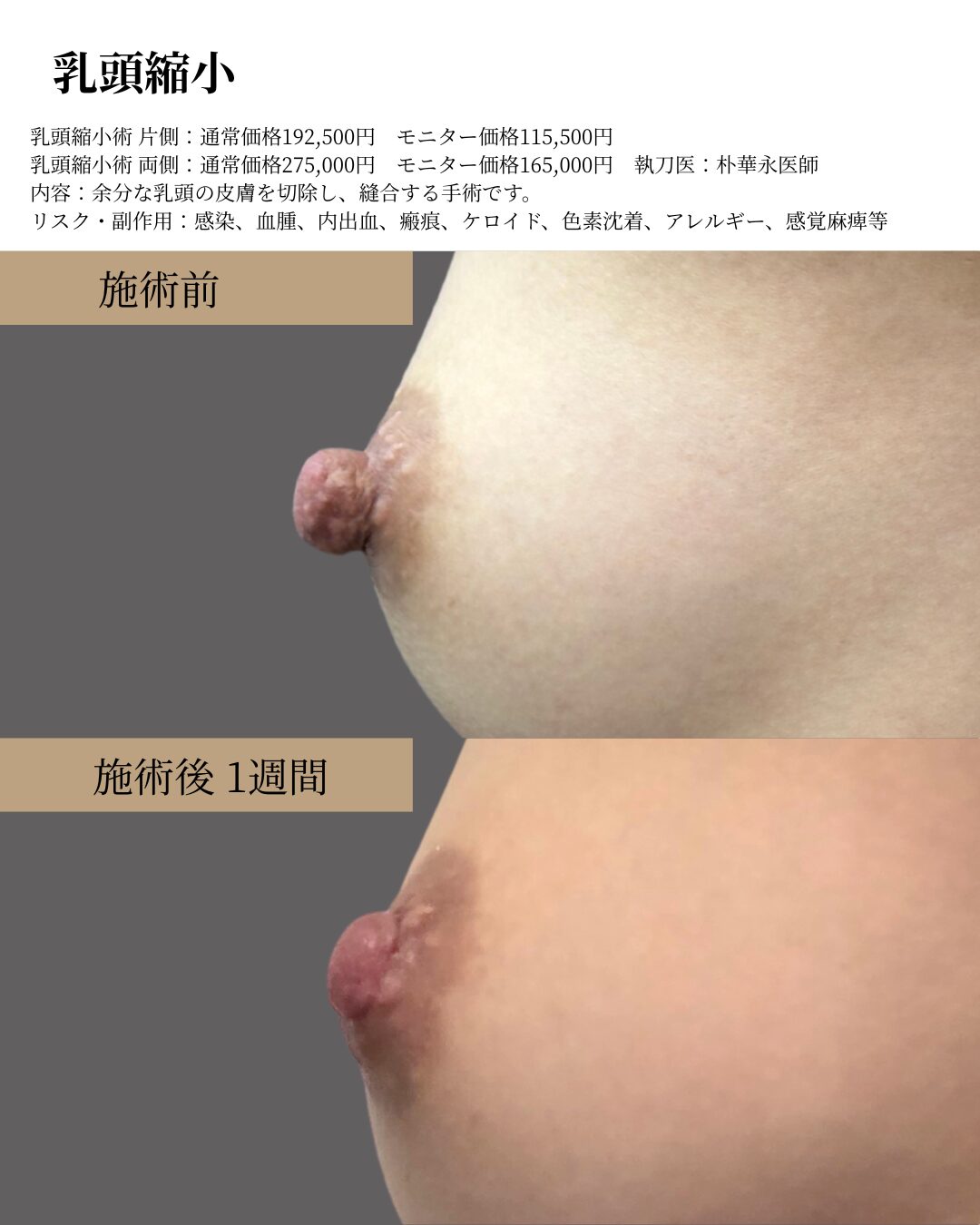 乳頭縮小