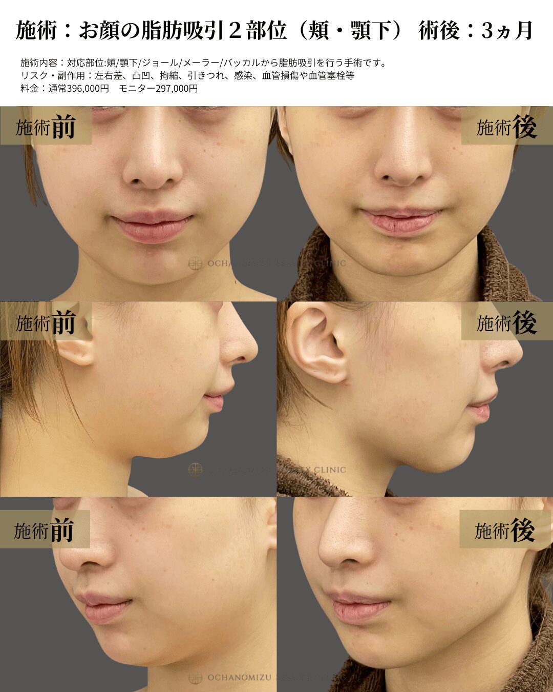 お顔の脂肪吸引2部位（頬・顎下）