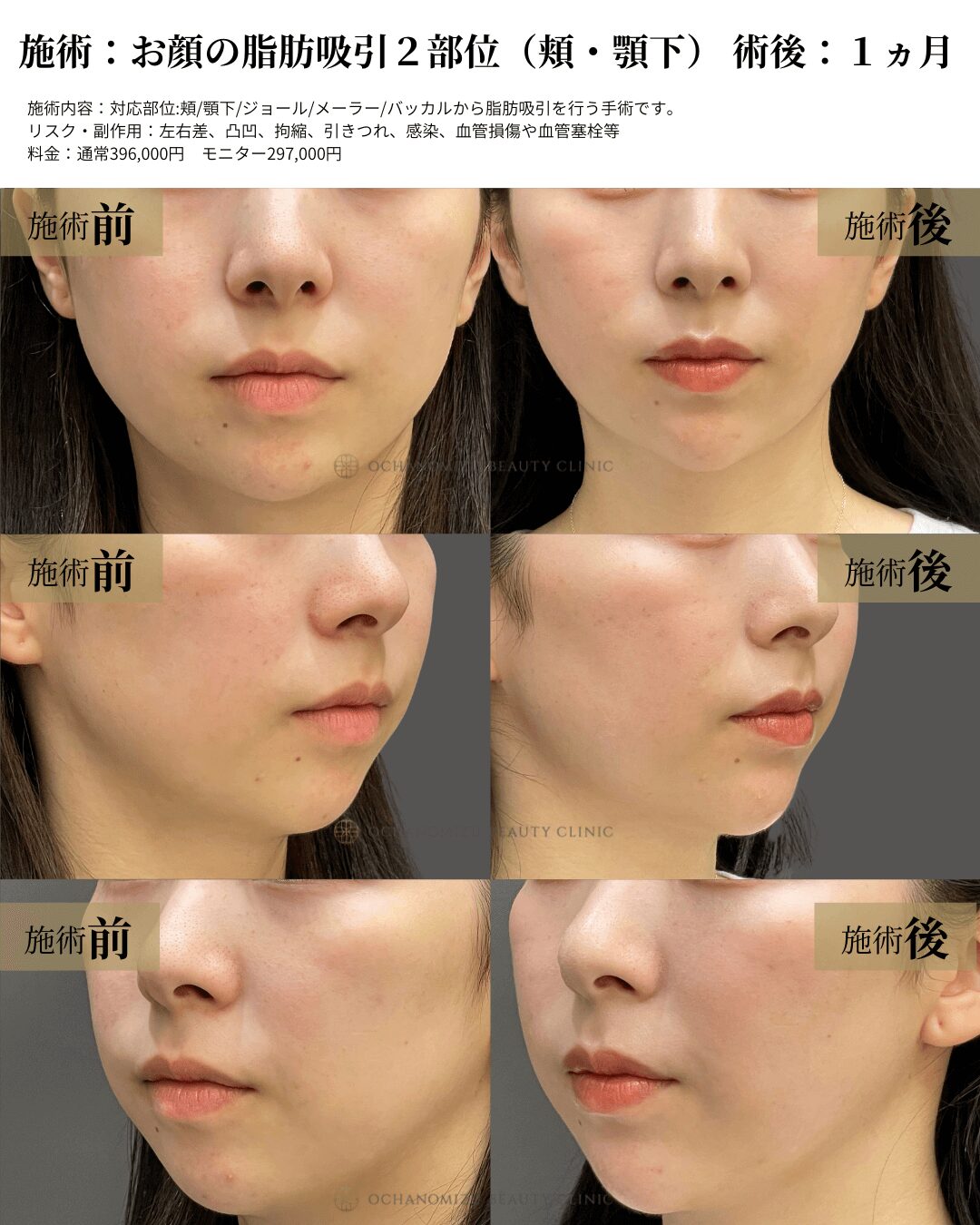 お顔の脂肪吸引2部位（頬・顎下）