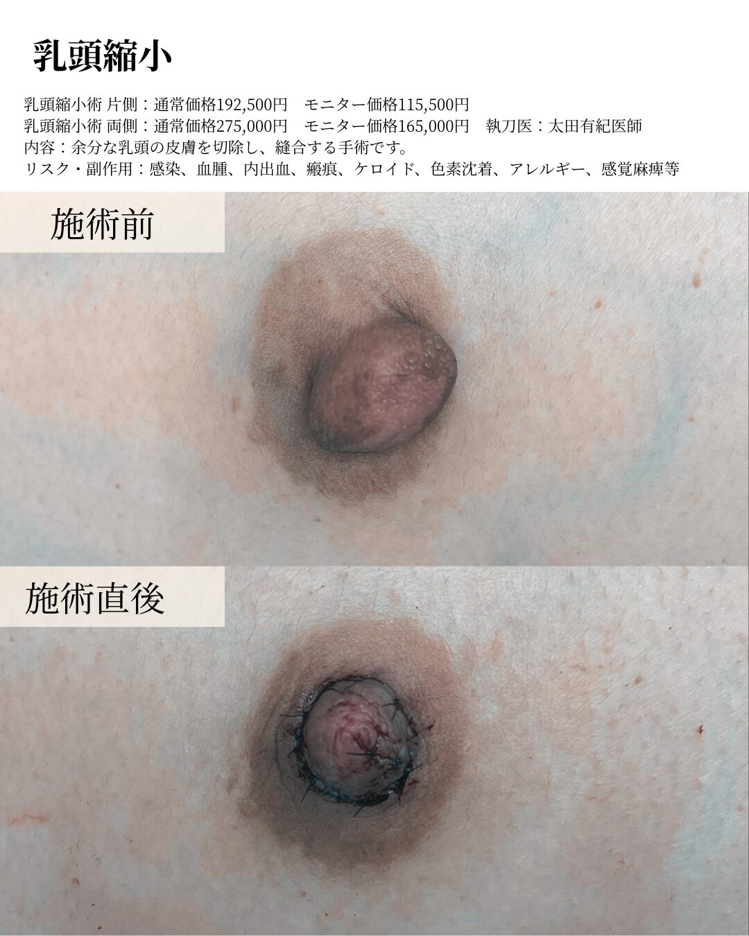 乳頭縮小