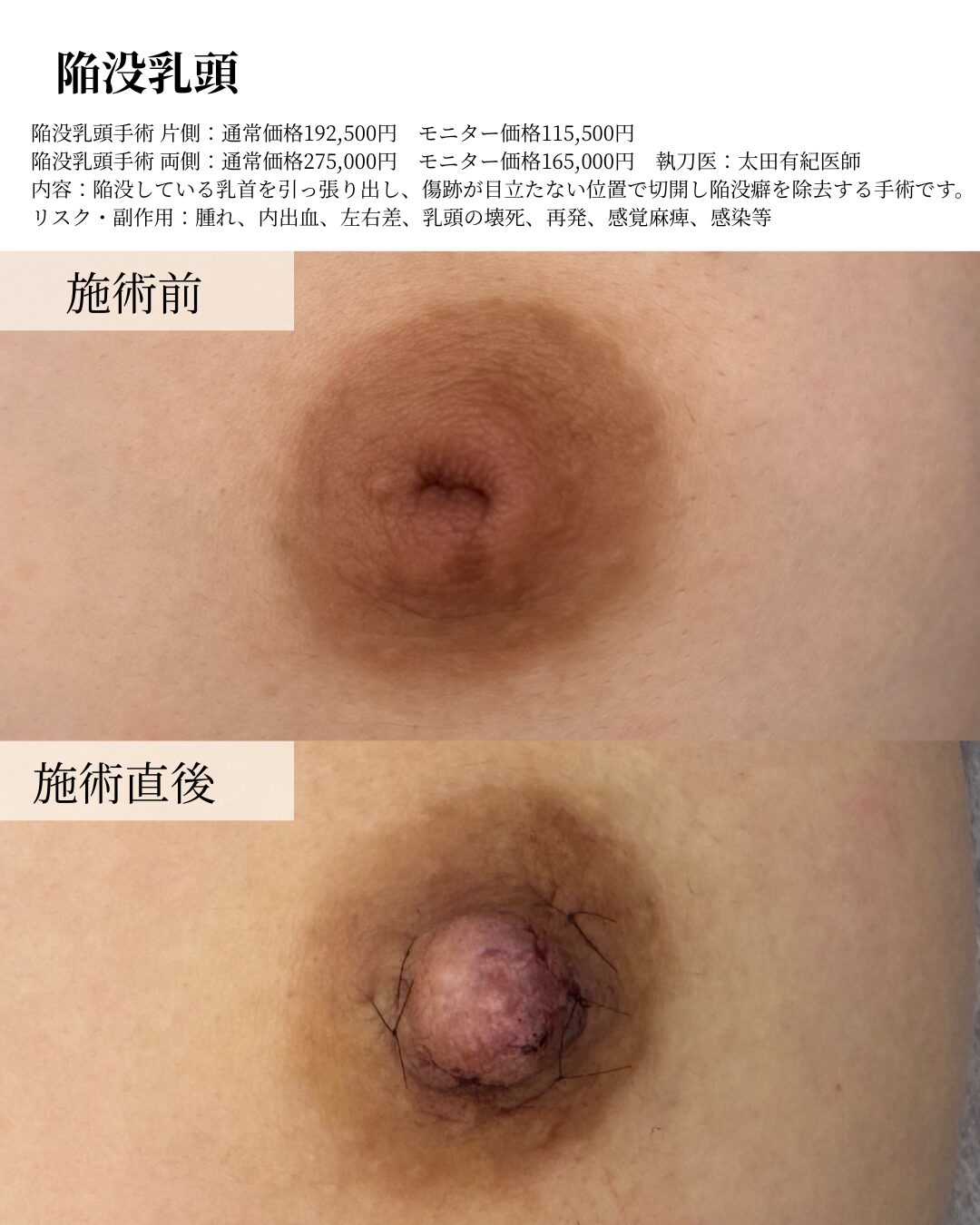 陥没乳頭