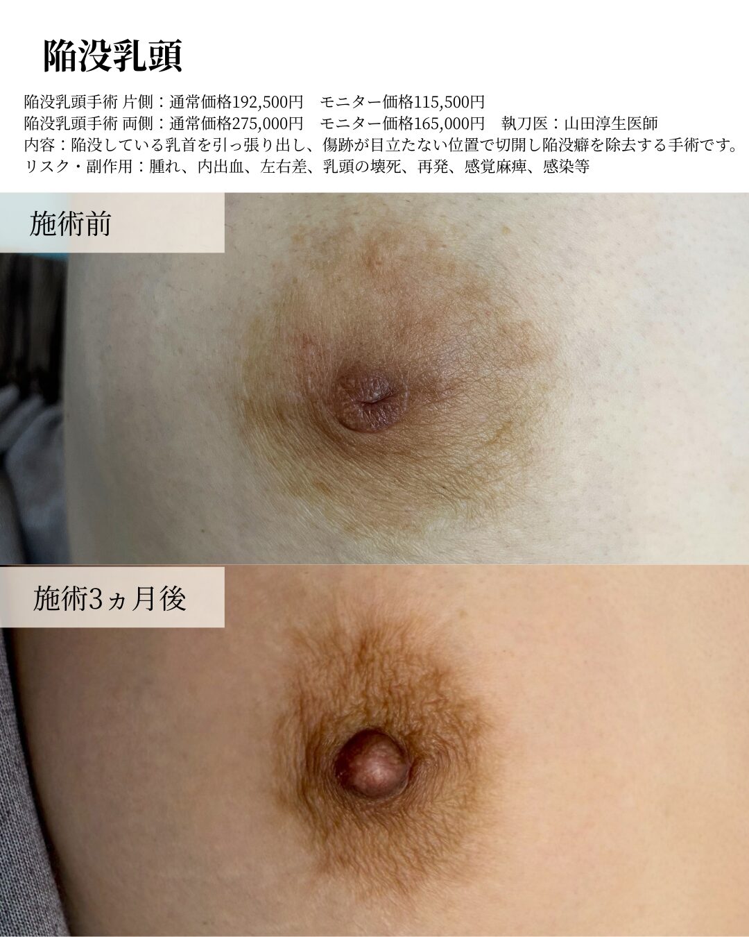 陥没乳頭
