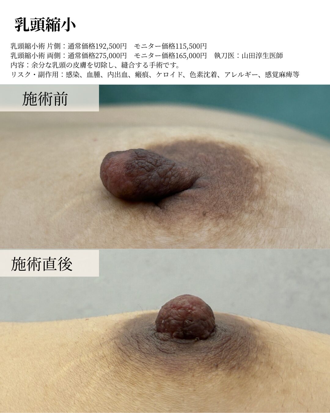 乳頭縮小