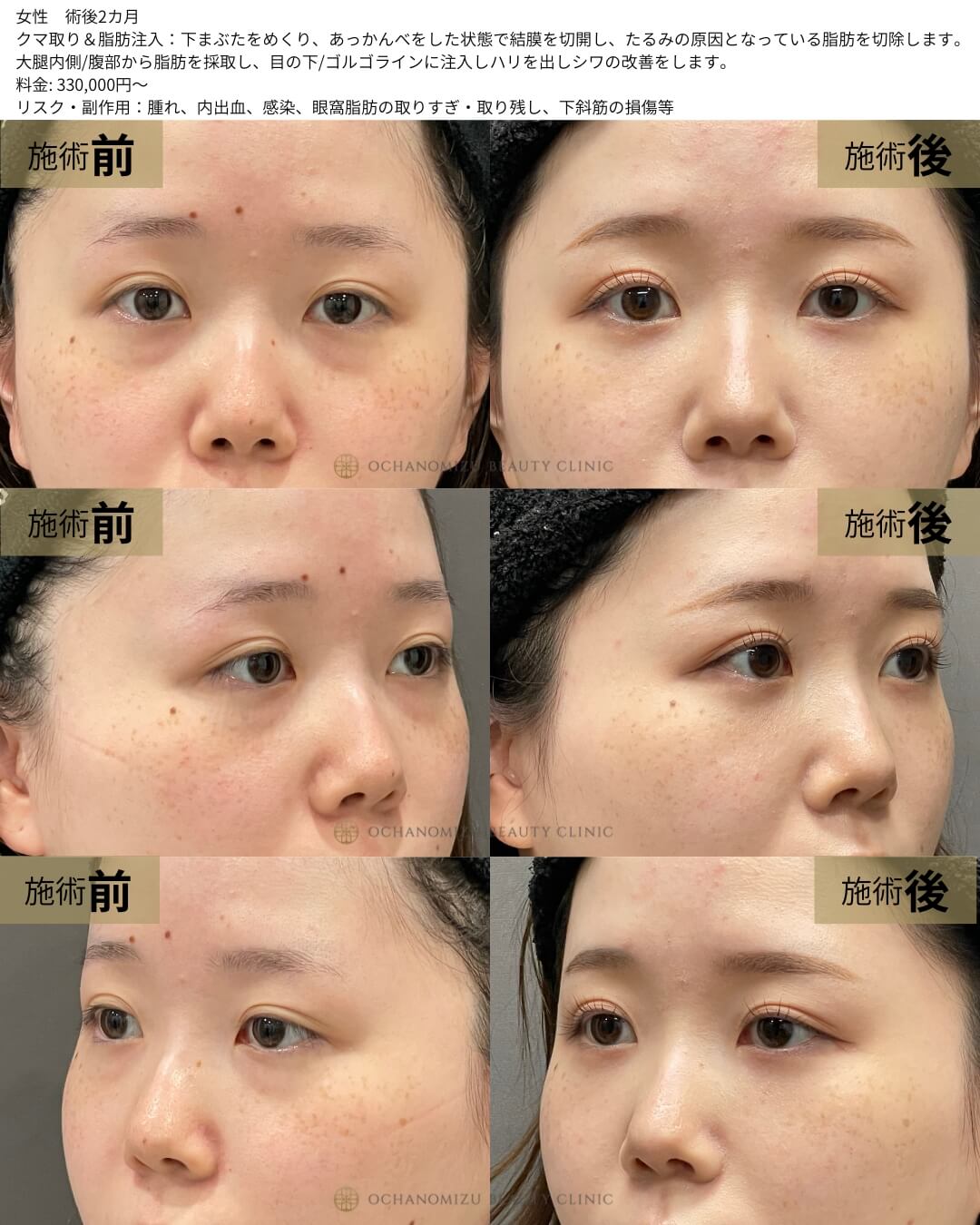 クマ取り＆脂肪注入